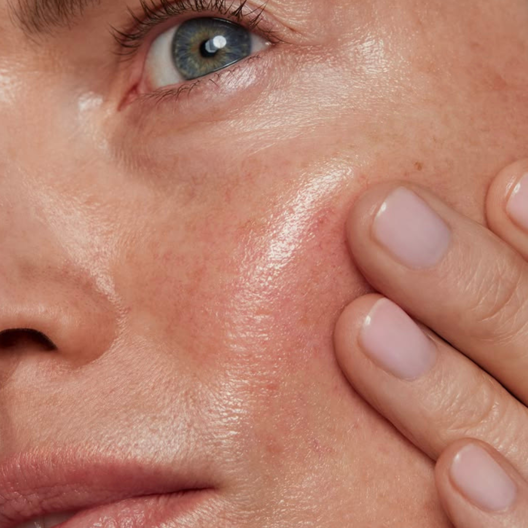 Understanding Rosacea: How to care for sensitive, redness-prone skin