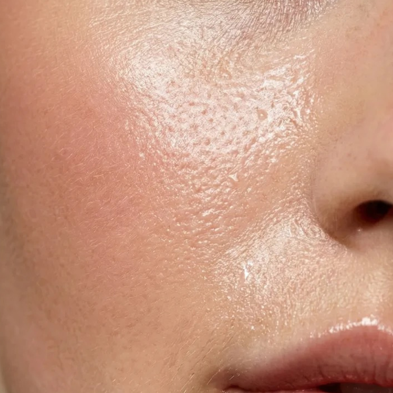 Oily Skin explained: What causes it and how to keep it balanced