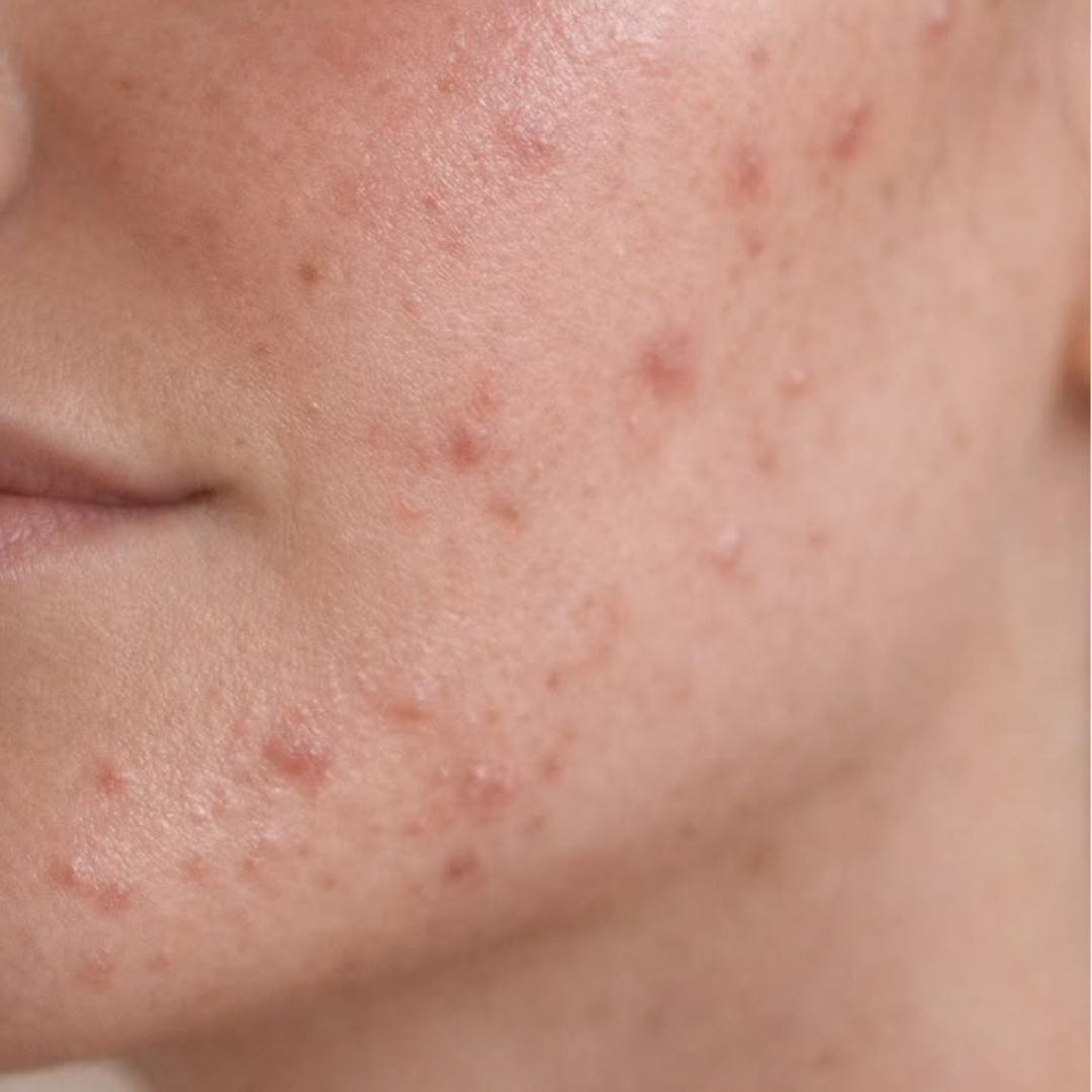 Fungal Acne Do’s & Don’ts: How to Care for Fungal Acne-Prone Skin